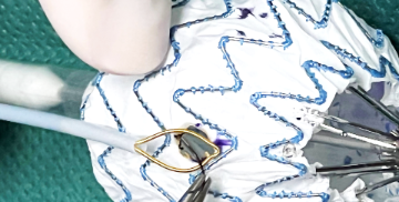 Studio internazionale pubblicato sul Journal of Vascular Surgery