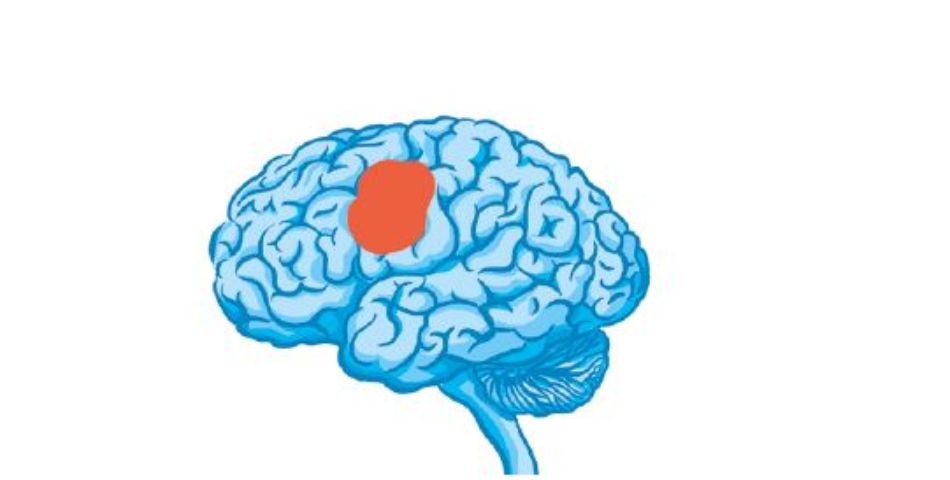 Patologia Neurovascolare: l’importanza dell’approccio multidisciplinare